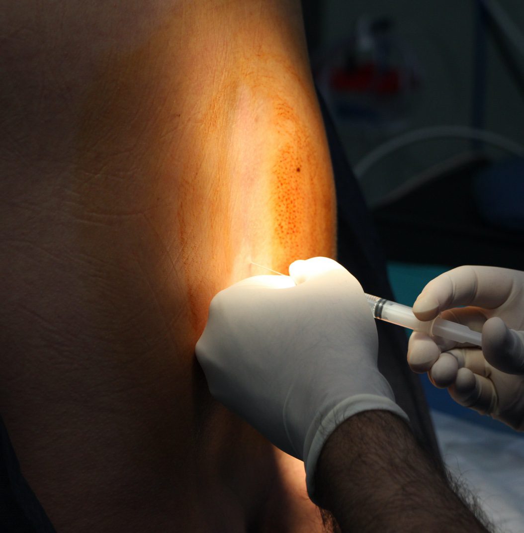 A gloved hand guides a needle and syringe into a patient&rsquo;s back under focused light